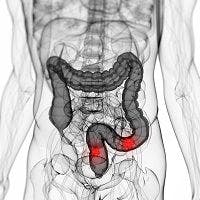 Colon Cancer Risk for New Generation of Weight-loss Drugs