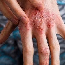 Study Demonstrates Efficacy, Safety of Topical PF-07038124 for Eczema, Psoriasis
