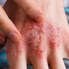 Antioxidants Safe and Effective for Atopic Dermatitis Management