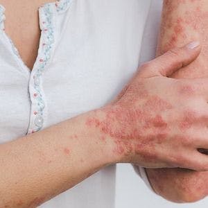 Research Shows Dose Escalation of Adalimumab May be Effective for Psoriasis