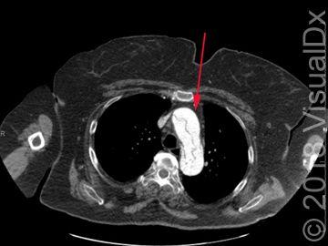 Image IQ:  Ripping chest pain and leg weakness