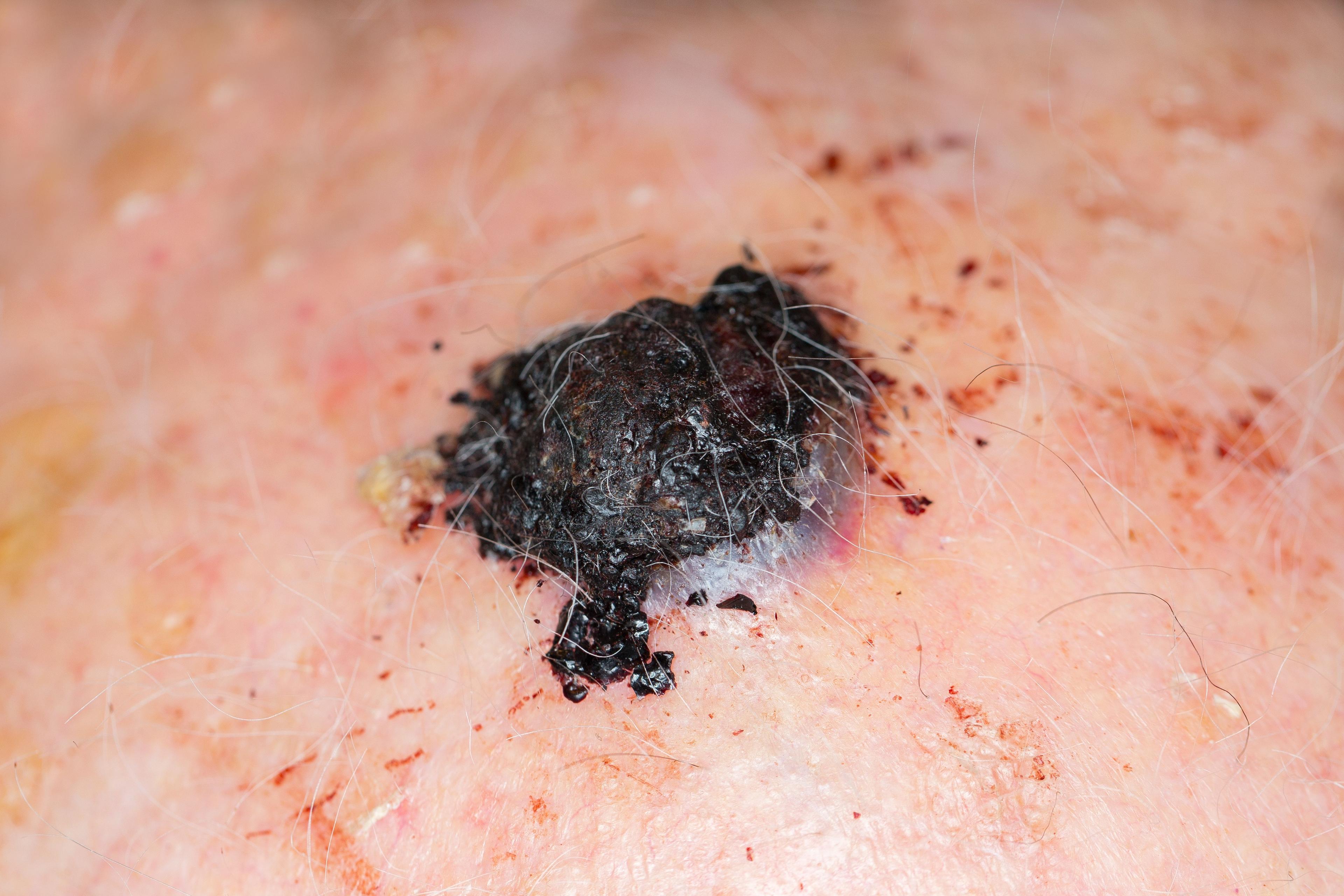 Melanoma Risk for Patients Treated With Biologics Is Inconclusive