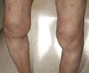 Elderly Woman With Odd Knees