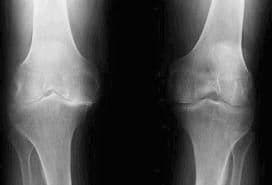 Osteoarthritis is More Than Wear and Tear