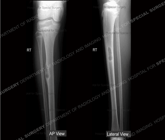 Worrisome Mass on a Young Lad's Tibia