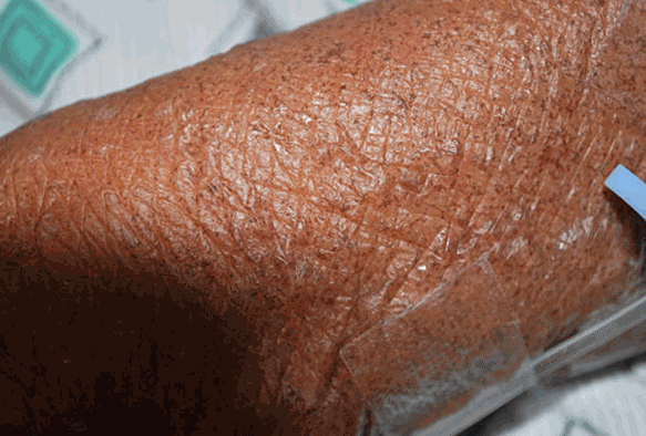 Disseminated Rash Accompanied by Abdominal Symptoms