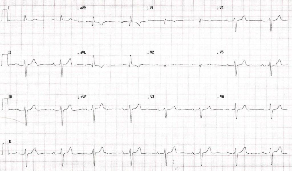 Sinus bradycardia