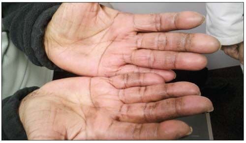 Mechanic’s Hands in a Patient With Antisynthetase Syndrome