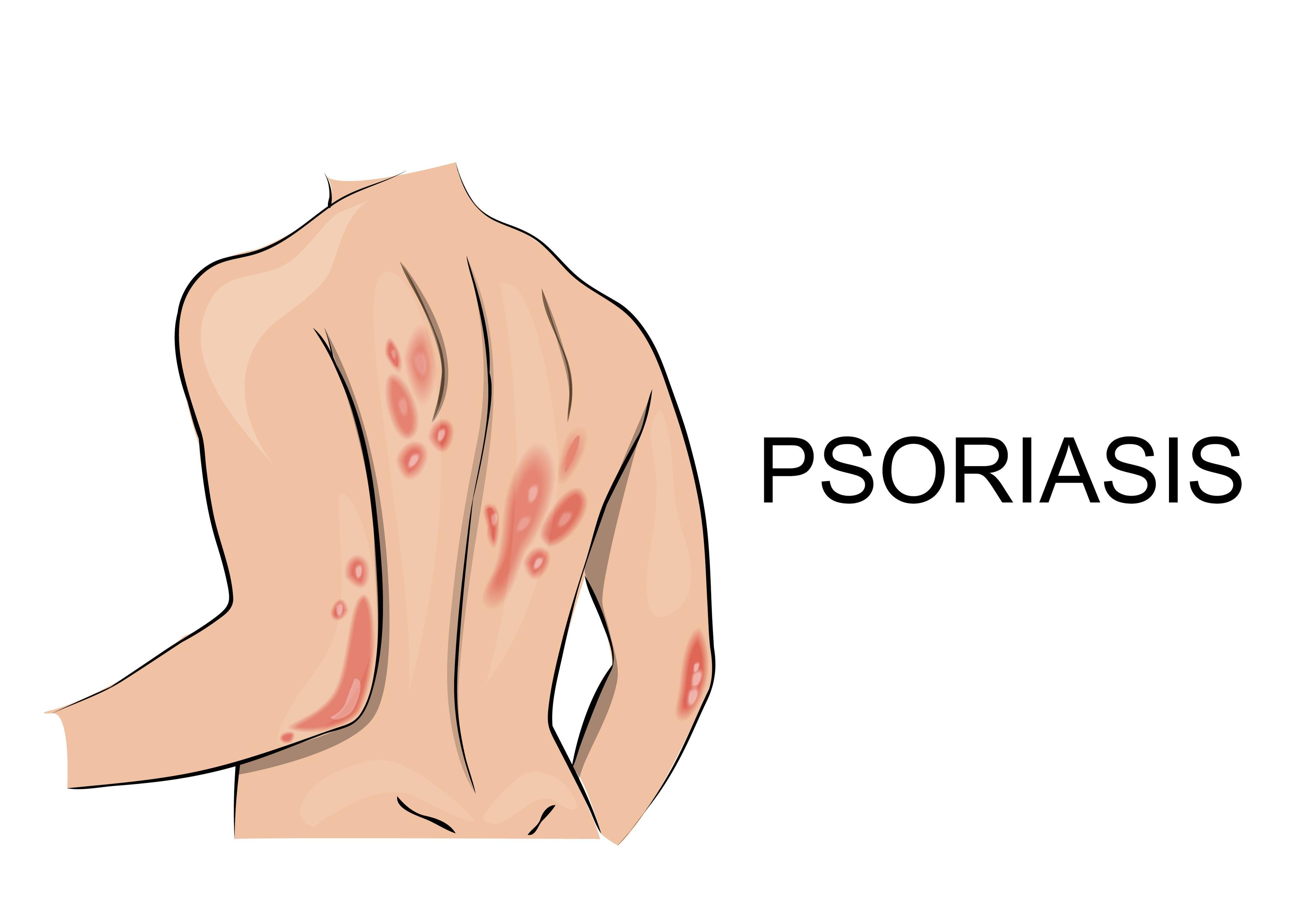 Central Obesity, the Liver and Heart in the Psoriatic Patient