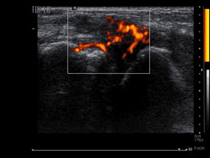 Synovitis Common in Ultrasounds of RA Patients in "Remission"