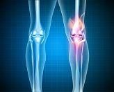 New Osteoarthritis Algorithm Based on Cartilage Degeneration