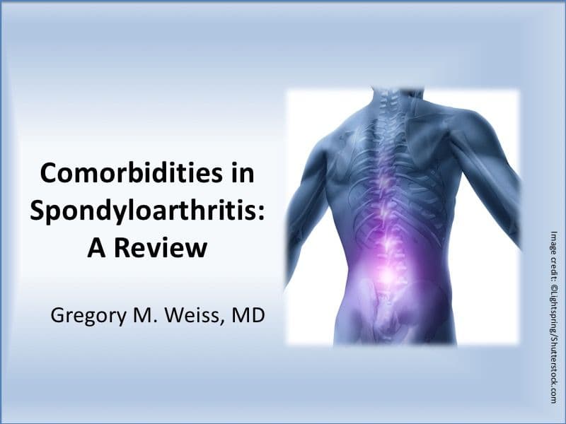 Comorbidities in Spondyloarthritis: A Review