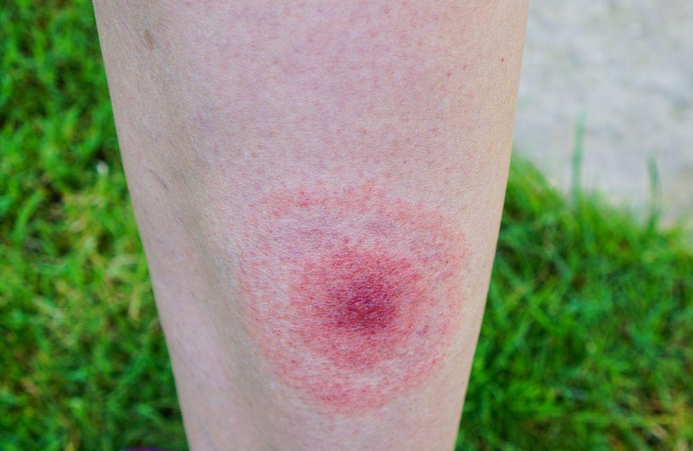 Lyme disease rash (©AnastasiaKopaShutterstock.com)