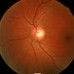 Retinal Imaging Increases Compliance for Annual Eye Exams