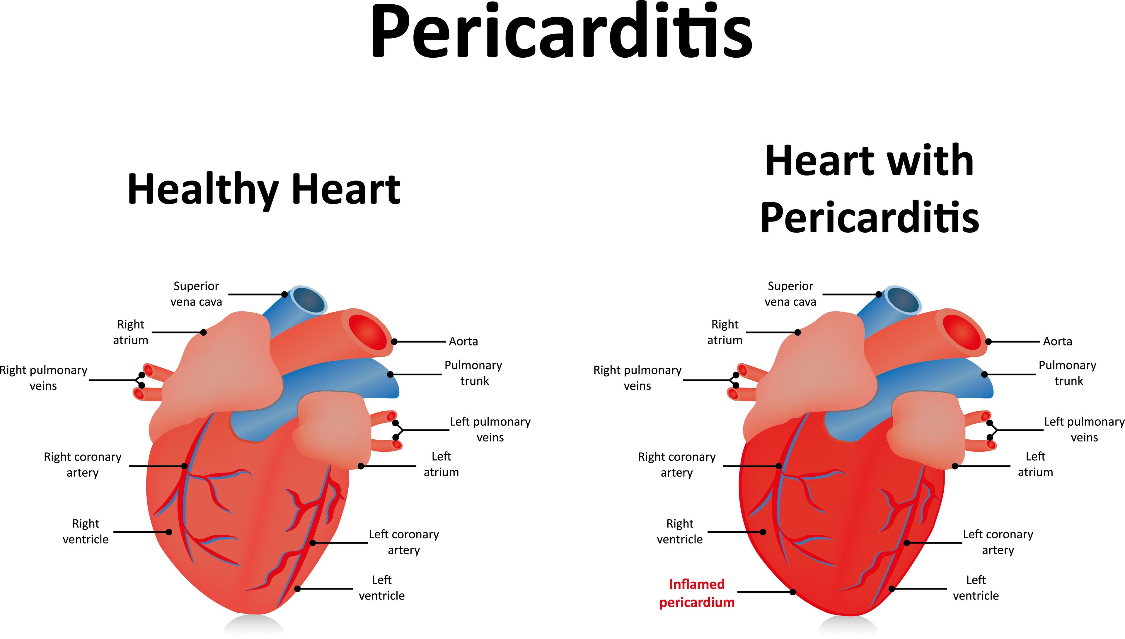 Pericarditis (©joshya/Shutterstock.com)