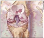 Current Approaches to Pain Management for Patients With Osteoarthritis