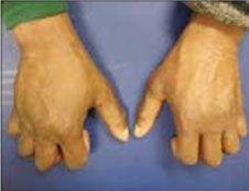 Bilateral Hand Swelling: Clue to What Condition?