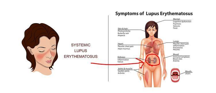 Belimumab Promising as Adjunct Therapy for Lupus Nephritis