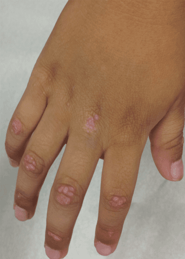 Boy With Muscle Weakness and Papules on His Hands