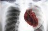 New Gene Expression Test will make Diagnosing Coronary Artery Disease Simpler