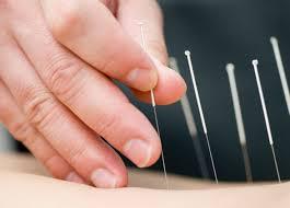 Acupuncture Shows Little Benefit for Knee Pain