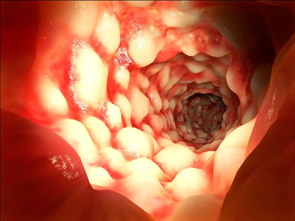 Anti-TNF-α Therapy Linked With Inflammatory Bowel Disease