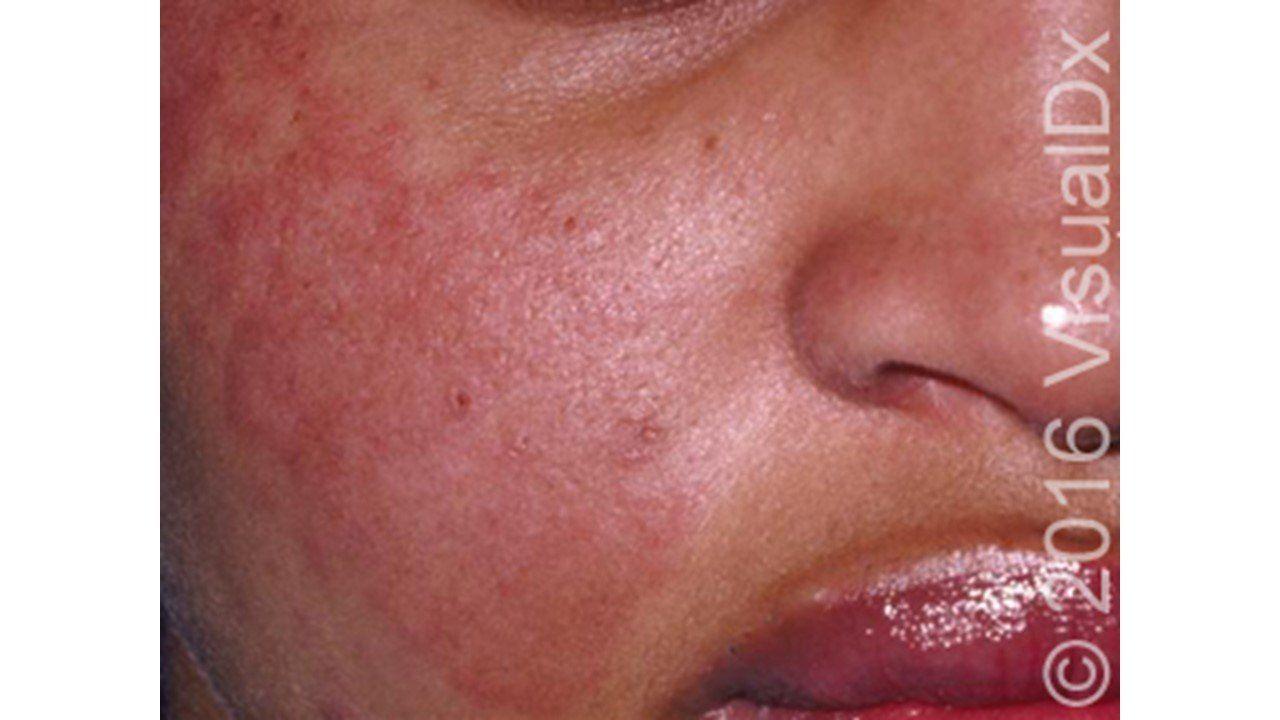 Systemic lupus erythematosus