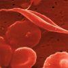 Compound May Prevent Painful Sickle Cell Crises