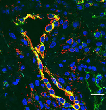 Interferon Mutation Causes Fatal Infant Vasculopathy 