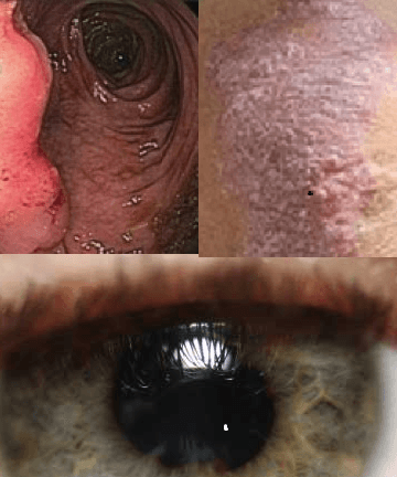 Eye, Skin, Bowel Signs Predate AS Diagnosis