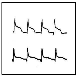 MI and Perhaps Stroke Risk Increased in Sjögren Syndrome