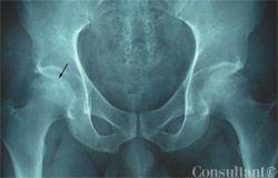 Photo Essay: Images of Hip Pain