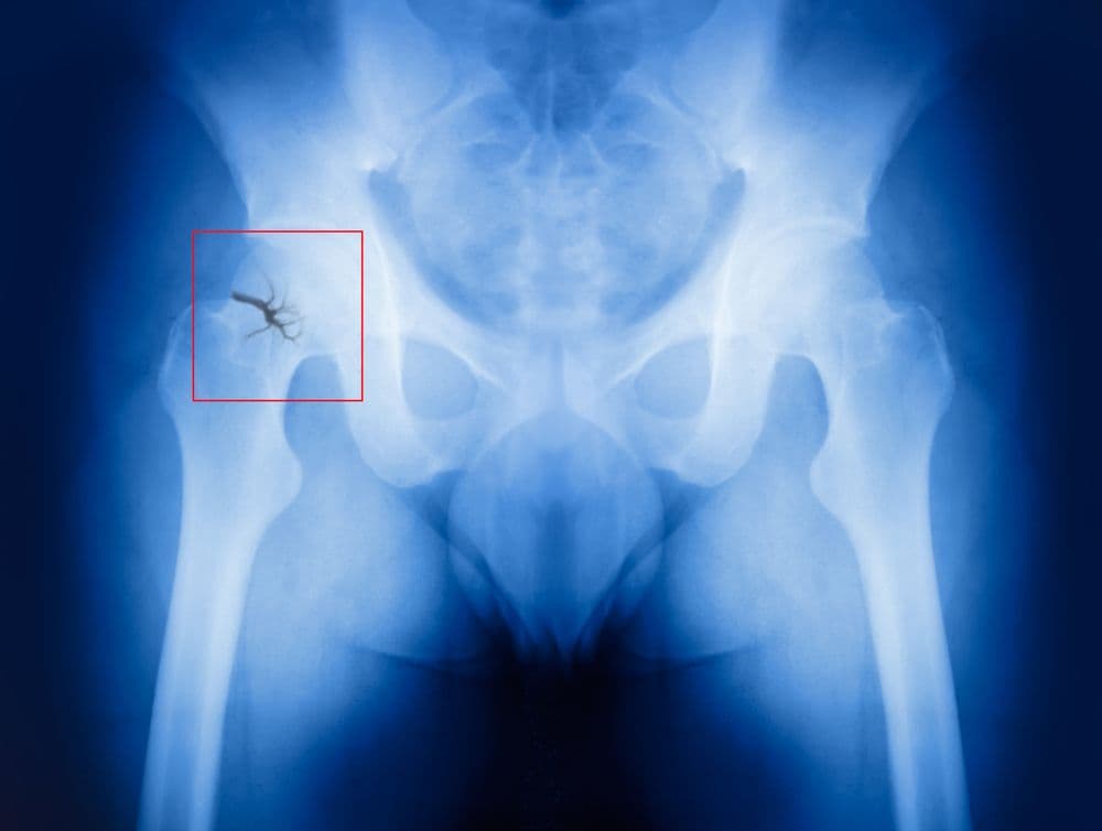 X-ray, Broken hip (©Muratart/Shutterstock.com)