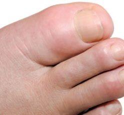 Even Costly Febuxostat Combos Found Cost-Effective for Gout