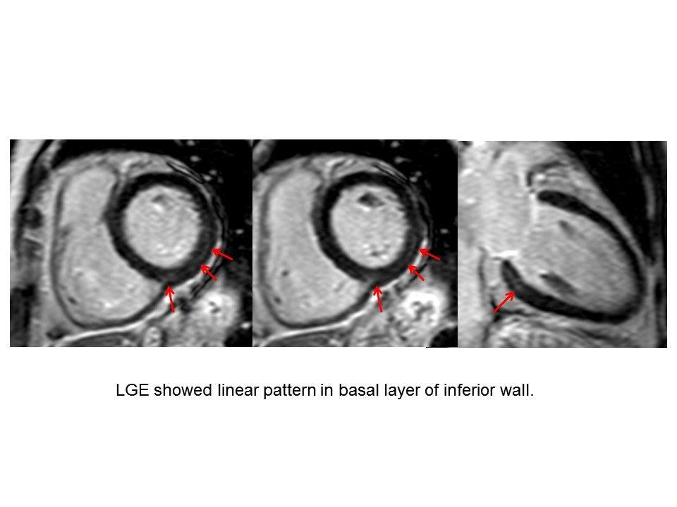 Myocardial Inflammation in Rheumatoid Arthritis