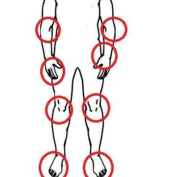 psoriatic arthritis