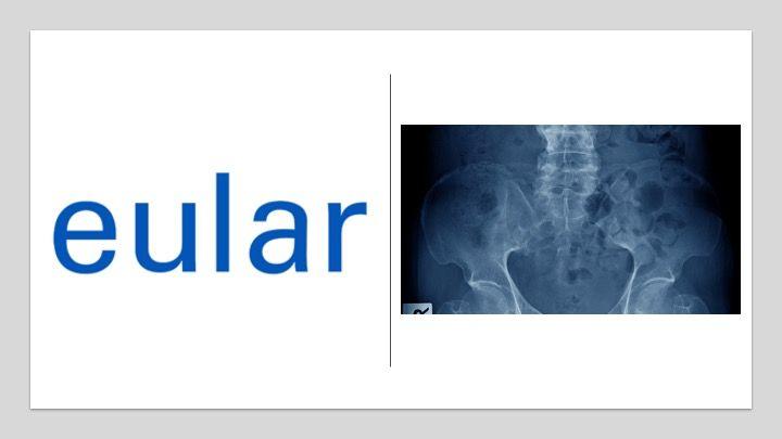 EULAR Report:  Ixekizumab Approved for Axial Spondyloarthritis