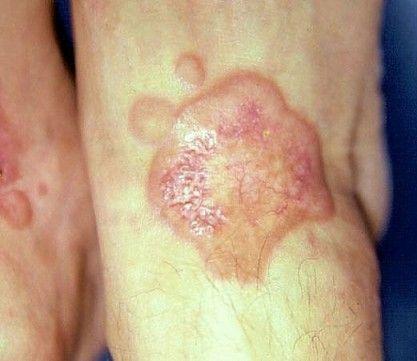 Yellowish Lesions on Feet