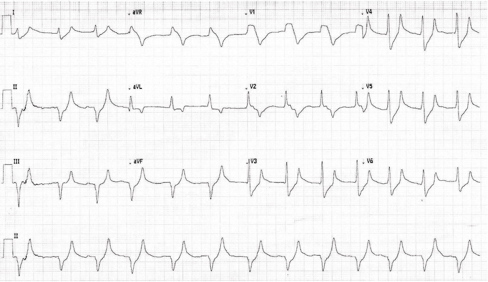 A patient's EKG reading