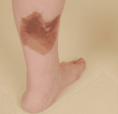 Painless Brown Plaques on a Sarcoidosis Patient's Legs