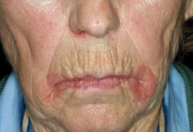 Pruritic, Burning Perioral “Lesions”: Your Dx?