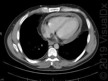 Image IQ: Sharp Pleuritic Chest Pain, Shortness of Breath, Fever, Myalgia