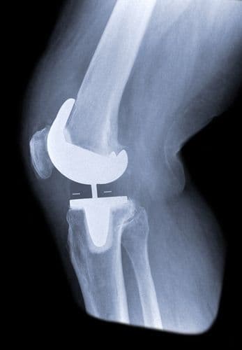 Knee Replacements: Big Data Favors Larger Procedures?