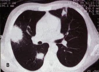 granulomatosis_with_polyangiitis