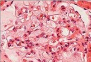 "foamy" glomerus in Fabry disease