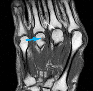 Don't Stop RA Treatment at Remission: Inflammation Outlasts It