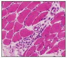 Diffuse Macular Hyperpigmented Rash and Weakness in an African American Woman