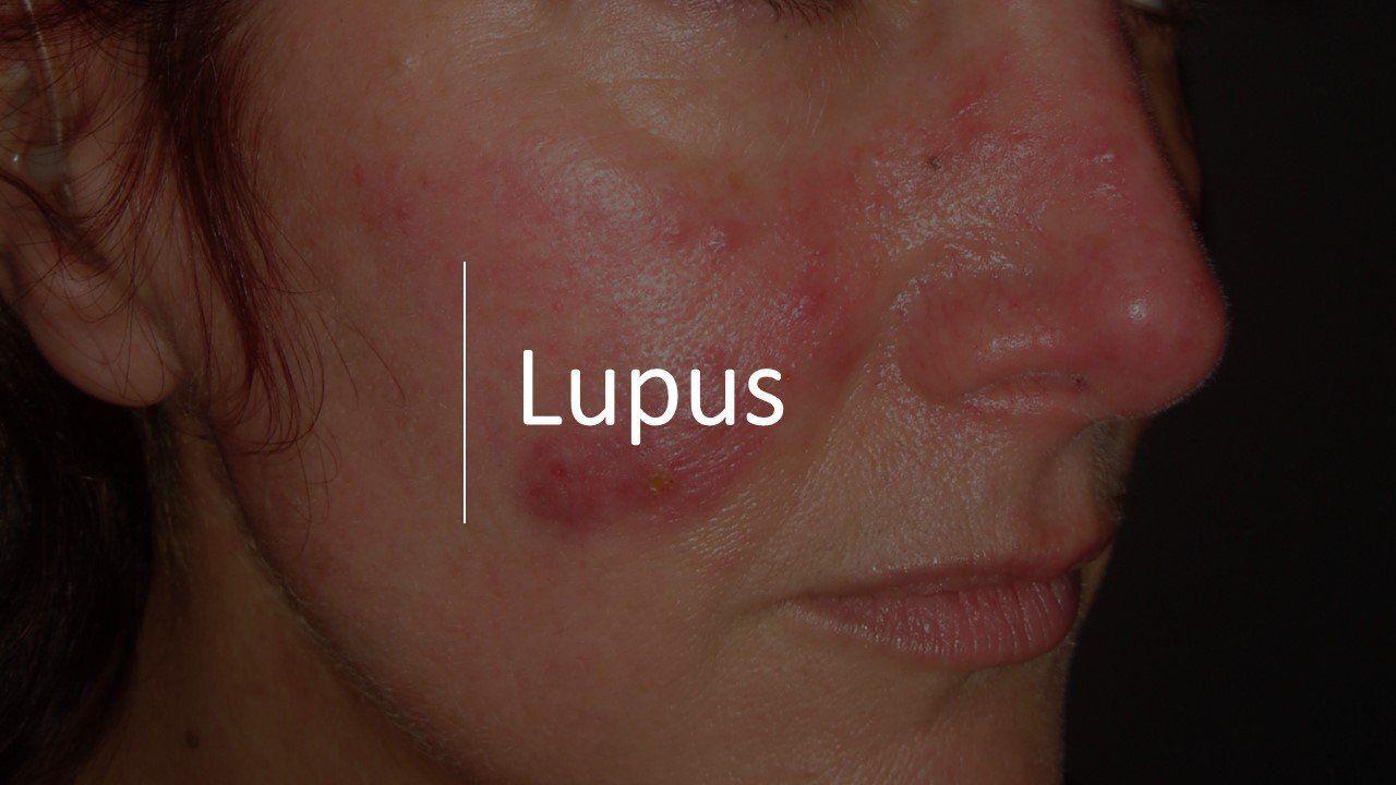 Turning Points in Research for Systemic Lupus in 2019