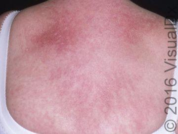 clinical quiz chest rash