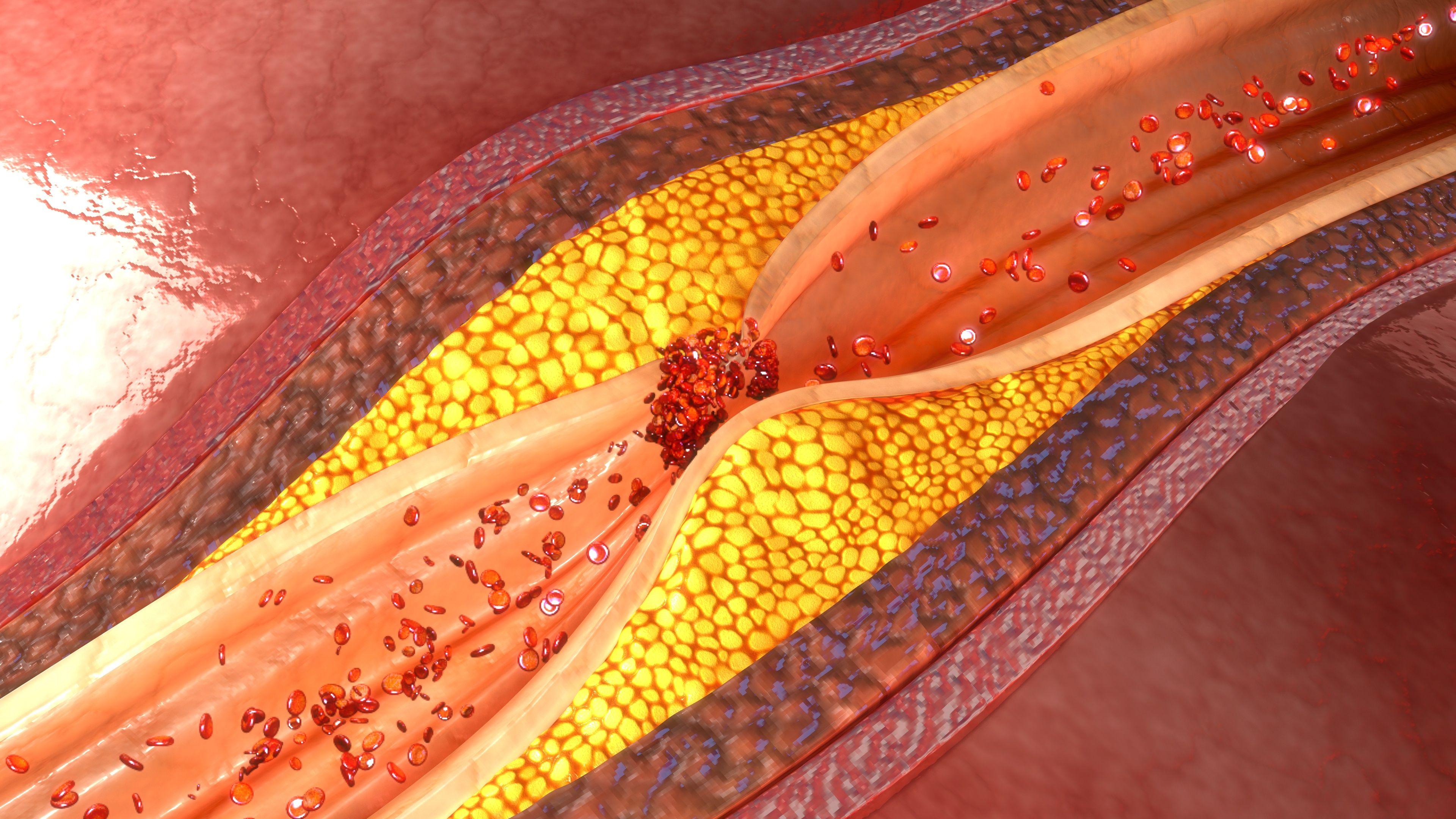 coronary plaque